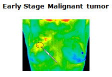 ThermoEarlyStageMalTumor