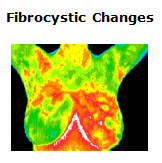 ThermoFibrocysticChanges