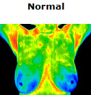 thermoNormalBreast